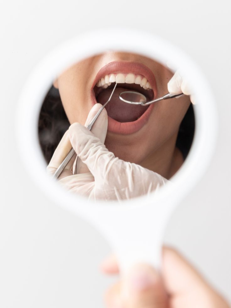 amalgám tömés cseréjének fontossága