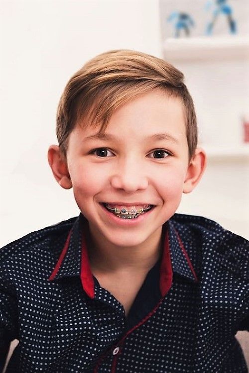 Gyerekkori fogszabályozás előnyei – 9 ok, amiért nem érdemes késlekedni