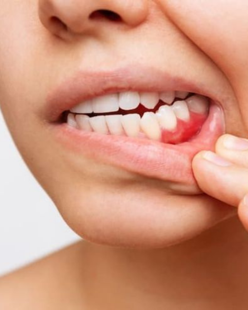 A hormonok hatása a fogakra és az ínyre – 7 meglepő változás, amit nem szabad figyelmen kívül hagyni